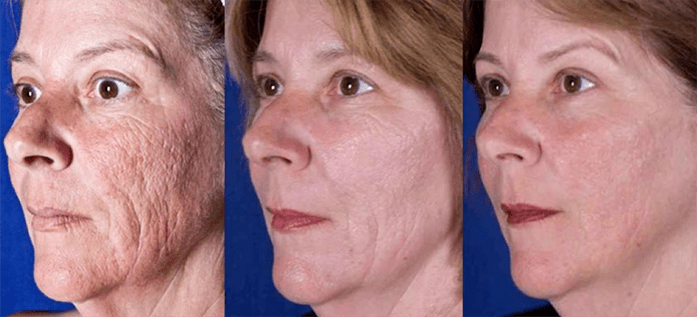 The result after laser facial skin rejuvenation