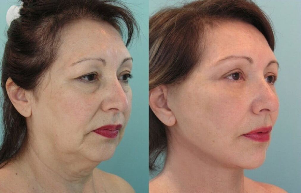 photography before and after skin rejuvenation